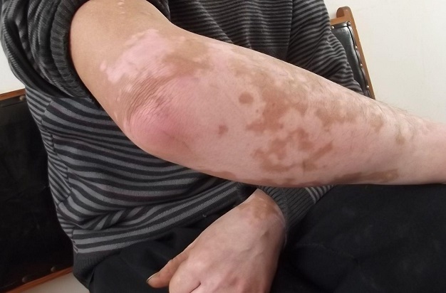 轻微白癜风能根治吗 轻度白癜风可以治得好吗