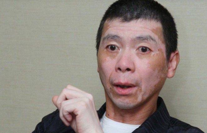 白癜风能彻底痊愈吗