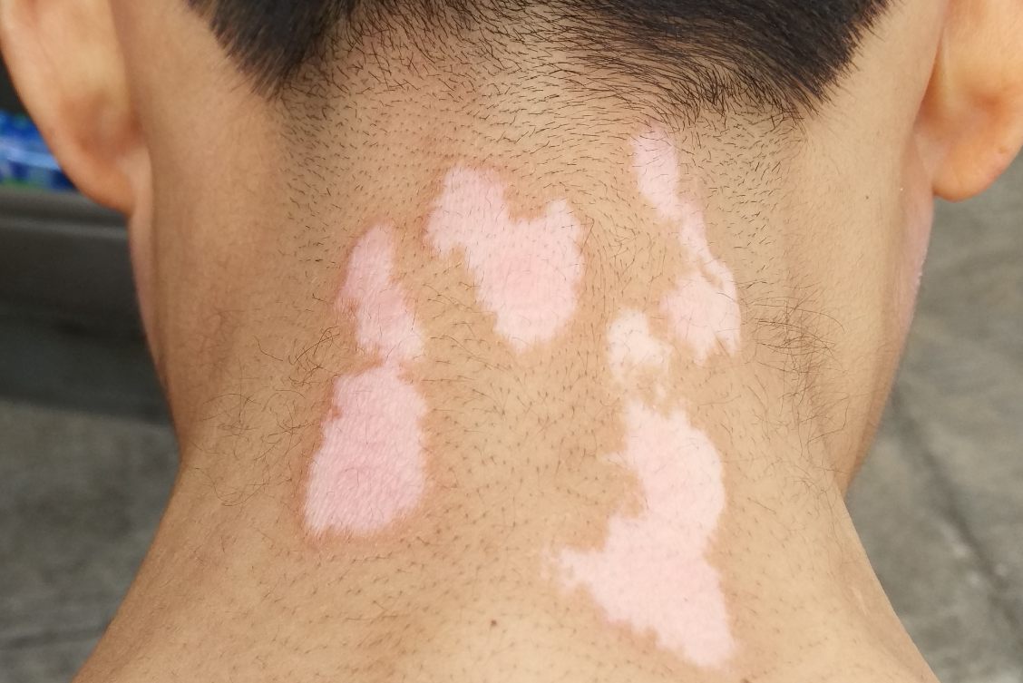白癜风的发病原因是什么 白癜风的主要发病原因