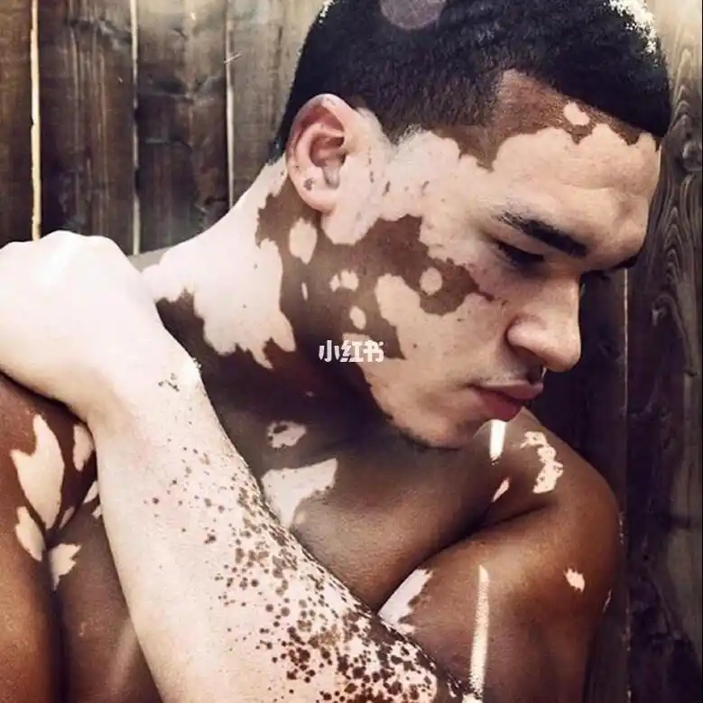 海南哪个医院治疗白癜风好 怎么判断是不是白癜风 海南哪个医院治疗白癜风好 怎么判断是不是白癜风