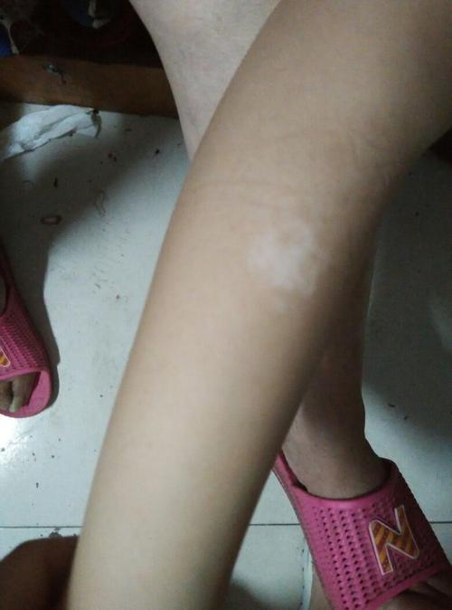 成都白癜风医院专家 老人的身上出现白癜风疾病该怎么办呢 成都白癜风医院专家 老人的身上出现白癜风疾病该怎么办呢