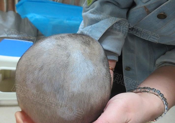 白癜风进展期与稳定期如何区分 石家庄治白癜风的医院哪所好 白癜风进展期与稳定期如何区分 石家庄治白癜风的医院哪所好