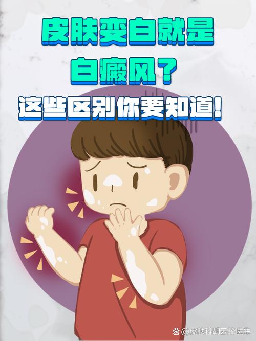 嘴唇白癜风难以治疗吗 嘴唇白癜风难以治疗吗