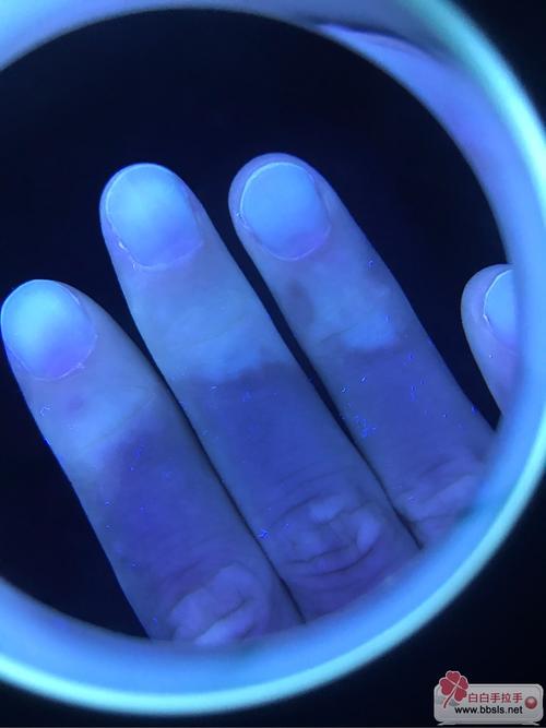 白癜风医生建议 白癜风治疗医生 白癜风医生建议 白癜风治疗医生