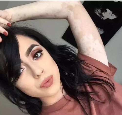 无锡哪里看白癜风好些 无锡哪里看白癜风好些