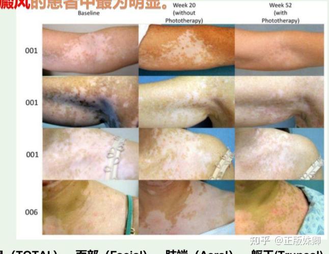 影响白癜风的病因是什么 影响白癜风的病因是什么