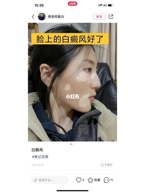 白癜风去苏州哪个医院 白癜风去苏州哪个医院