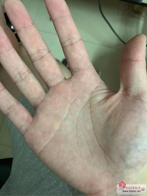 长沙哪有专科白癜风治疗为什么年轻人容易患白癜风 长沙哪有专科白癜风治疗为什么年轻人容易患白癜风