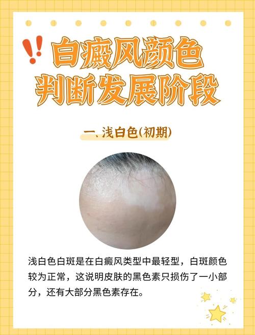 白癜风光疗仪使用的注意事项有哪些 郑州治疗白癜风好的专科医院 白癜风光疗仪使用的注意事项有哪些 郑州治疗白癜风好的专科医院