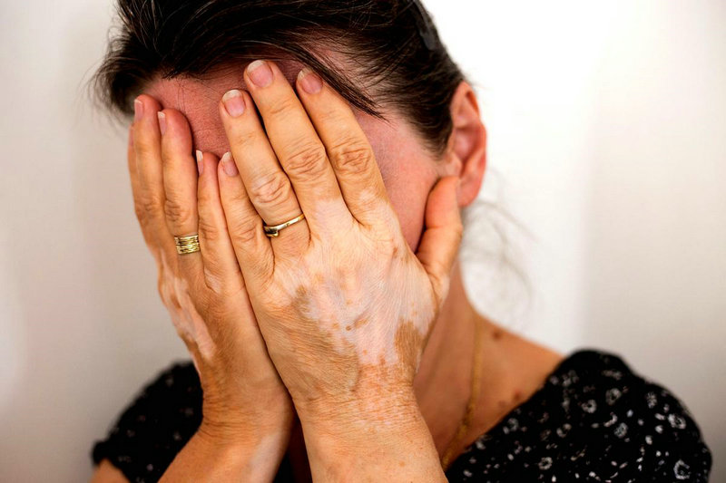 白癜风白斑上出现黑斑 白癜风白斑上出现黑斑