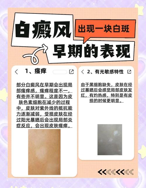 白癜风与体癣的区别在哪 南京到哪治白癜风效果好 白癜风与体癣的区别在哪 南京到哪治白癜风效果好