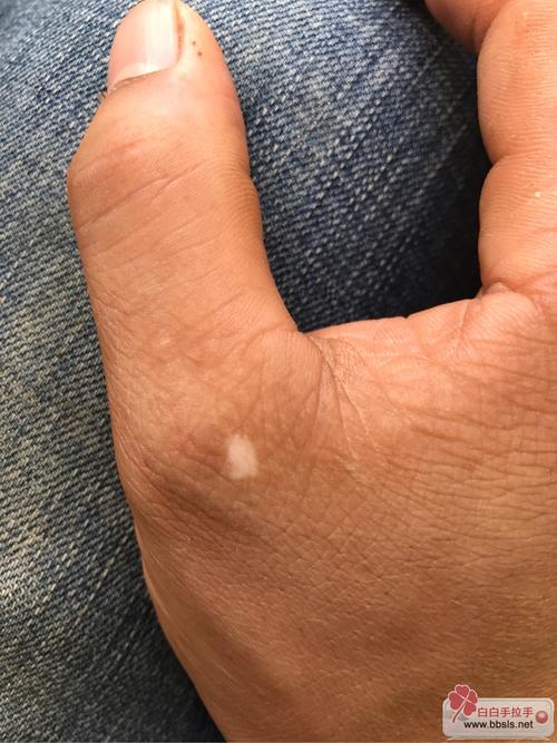 虫斑与白癜风有什么区别 蜀山治疗白癜风的医院 虫斑与白癜风有什么区别 蜀山治疗白癜风的医院