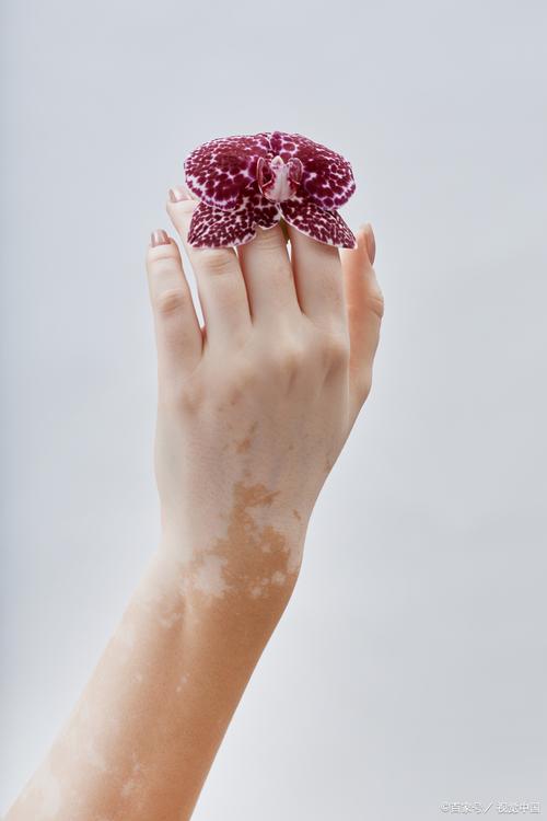 近期公布 兰州治白癜风手术哪家医院较好 儿童白癜风有哪些症状表现呢 近期公布 兰州治白癜风手术哪家医院较好 儿童白癜风有哪些症状表现呢