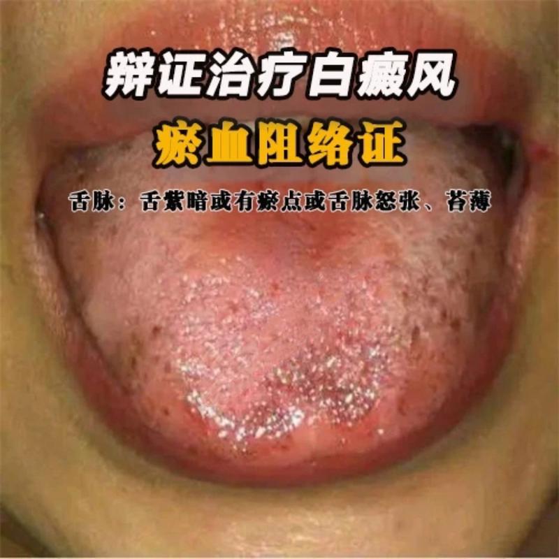 白癜风怎样可以快速治疗 白癜风怎样可以快速治疗