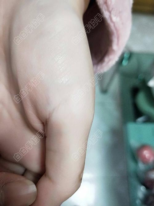 南昌哪家医院能看白癜风 南昌哪家医院能看白癜风