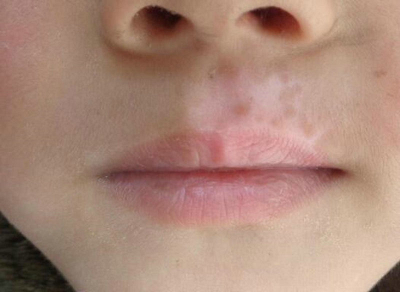 菏泽白癜风哪里看得好 菏泽白癜风哪里看得好