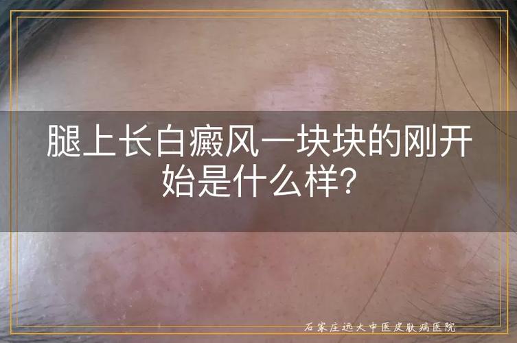 什么情况皮肤会长白癜风 什么情况皮肤会长白癜风