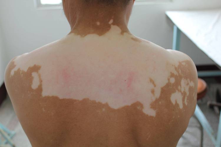 深圳主治白癜风的医院 怎么判断是不是白癜风 深圳主治白癜风的医院 怎么判断是不是白癜风