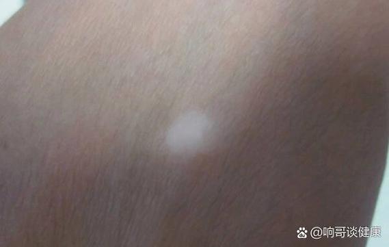 益阳治疗白癜风的医院 益阳治疗白癜风的医院