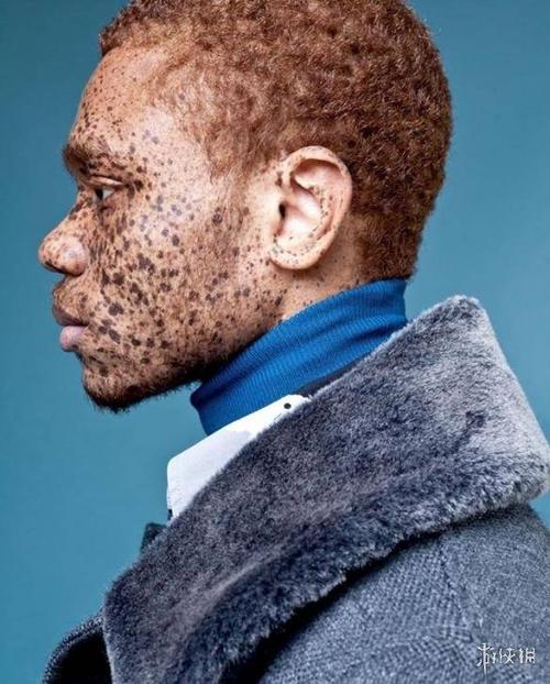 临沂省白癜风专科医院 白癜风怎样 临沂省白癜风专科医院 白癜风怎样