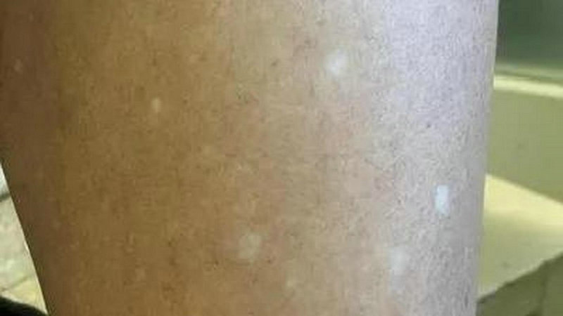 脖子起白癜风 脖子长白斑怎么治疗 脖子起白癜风 脖子长白斑怎么治疗