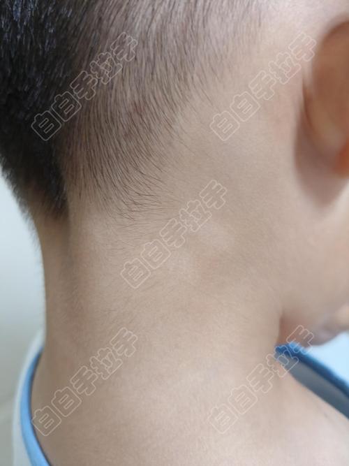 湖北襄阳白癜风医院药物 湖北襄阳白癜风医院药物