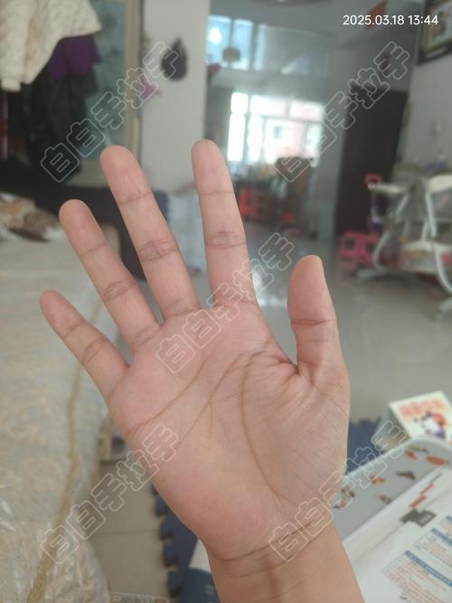 白癜风的症状 4个方法治疗白癜风 白癜风的症状 4个方法治疗白癜风