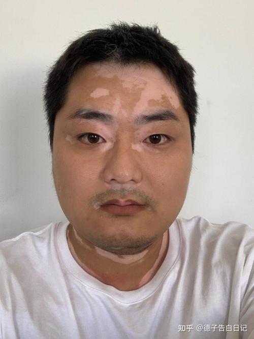 白癜风平时该如何的缓解压力 宁波哪个治白癜风的医院专业 白癜风平时该如何的缓解压力 宁波哪个治白癜风的医院专业