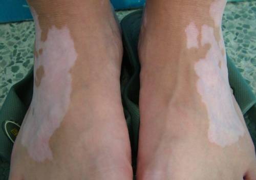 白癜风怎么中西医结合治疗 白癜风怎么中西医结合治疗