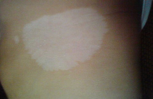 舟山皮肤病医院 为什么年轻女性更容易患白癜风 舟山皮肤病医院 为什么年轻女性更容易患白癜风