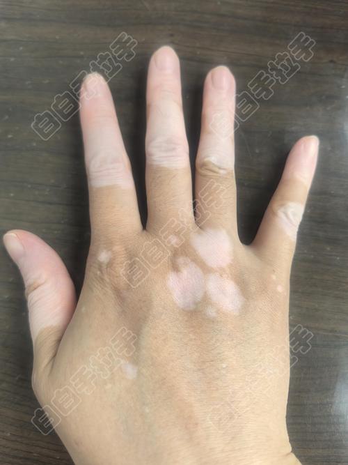 本月要闻广州治疗白癜风的医院哪家好位置透露白癜风治疗黄金时间是 本月要闻广州治疗白癜风的医院哪家好位置透露白癜风治疗黄金时间是