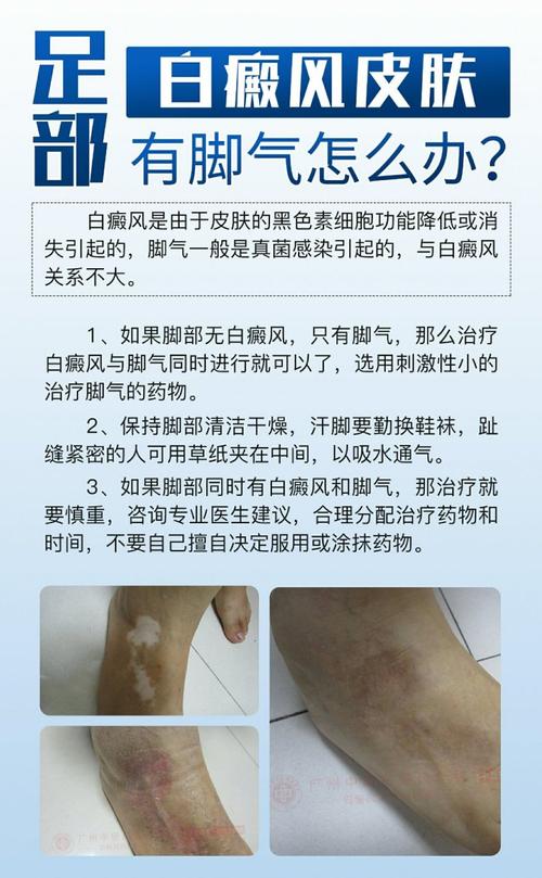 宁波白癜风医院哪里专业得了白癜风有哪些症状 宁波白癜风医院哪里专业得了白癜风有哪些症状