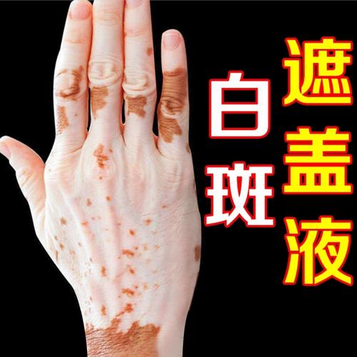 沈阳那家医院的白癜风 白癜风的自体表皮移植术是怎么回事 沈阳那家医院的白癜风 白癜风的自体表皮移植术是怎么回事