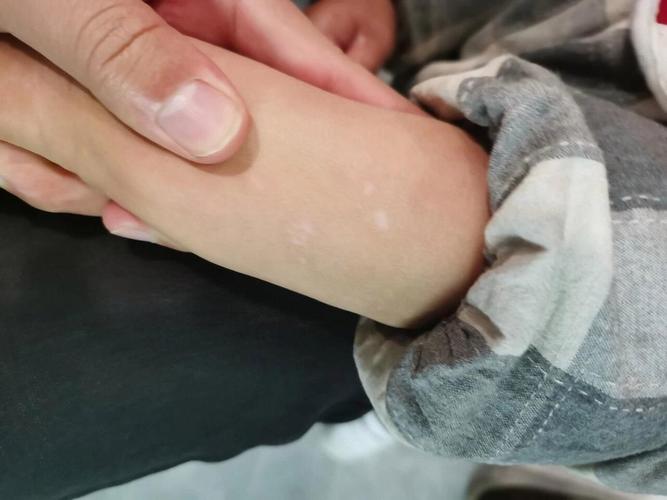 什么生活习惯导致白癜风 什么生活习惯导致白癜风