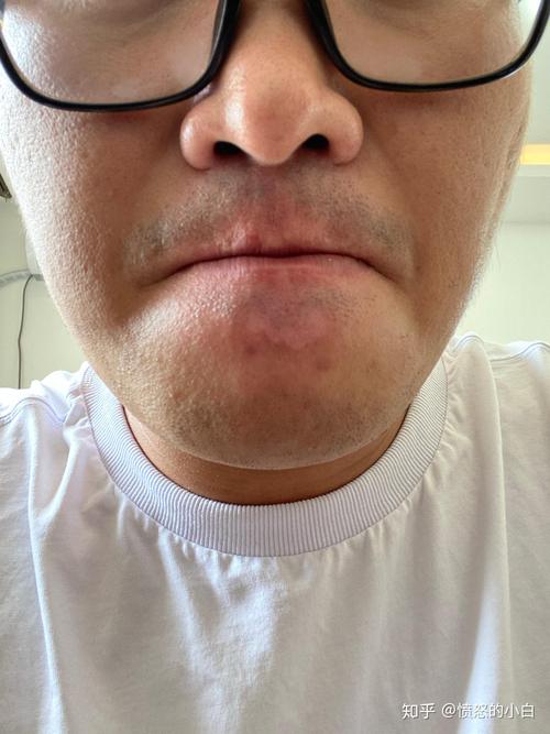 哪里治白癜风儿童 儿童白癜风最好选用 哪里治白癜风儿童 儿童白癜风最好选用