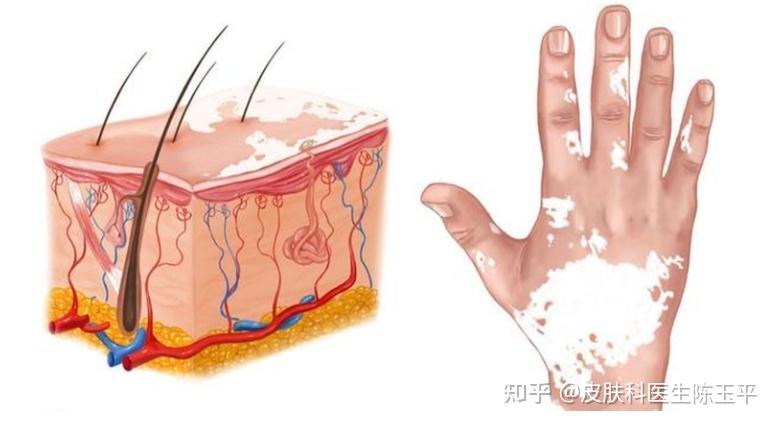 武汉白癜风网上挂号 白癜风武汉医院 武汉白癜风网上挂号 白癜风武汉医院