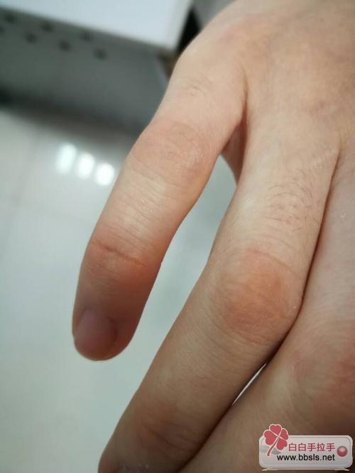 治疗白癜风特效新国药 治疗白癜风特效新国药