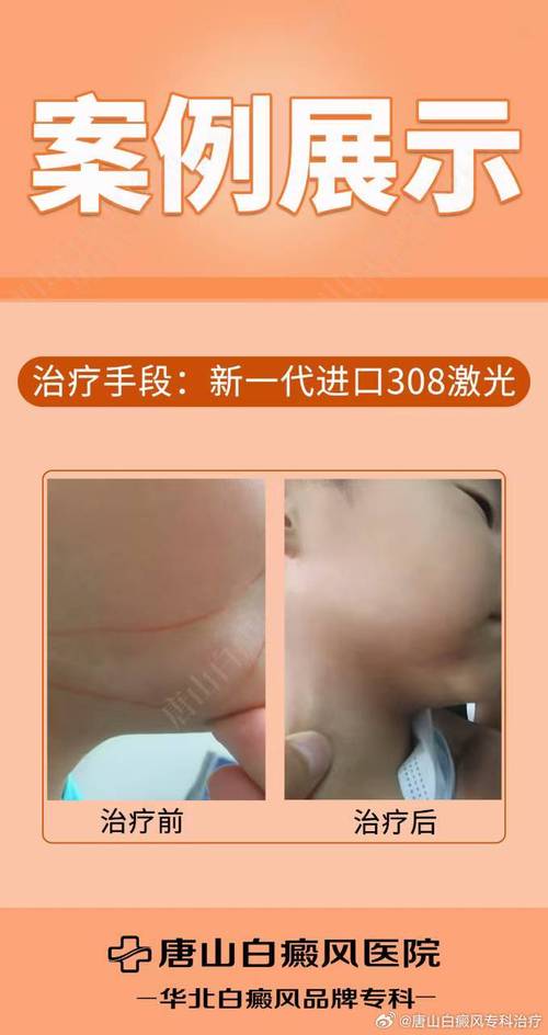 长沙治疗白癜风的医院有哪些是有效的白癜风怎么预防 长沙治疗白癜风的医院有哪些是有效的白癜风怎么预防