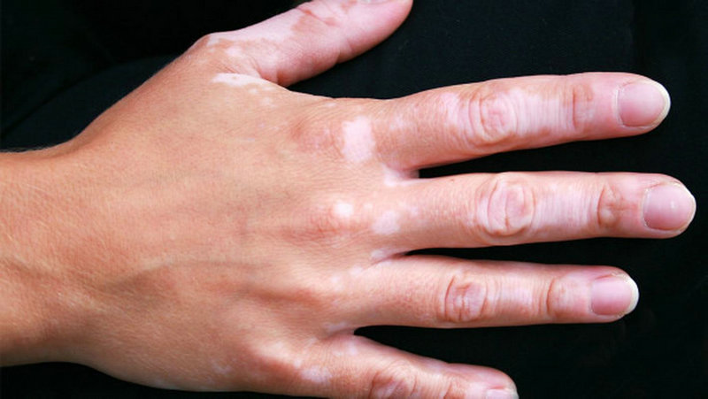 白癜风导读郑州白癜风专业医院详细名单儿童白癜风有哪些特征 白癜风导读郑州白癜风专业医院详细名单儿童白癜风有哪些特征