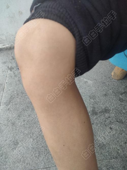 白癜风浑身痒怎么止痒 白癜风浑身痒怎么止痒