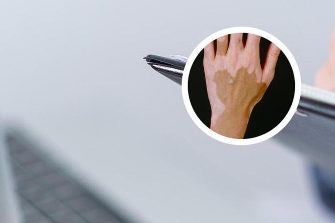 白癜风彻底根治还需多久 白癜风彻底根治还需多久