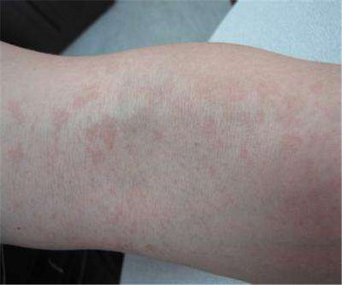 益掌通能治白癜风吗 益掌通的作用 益掌通能治白癜风吗 益掌通的作用