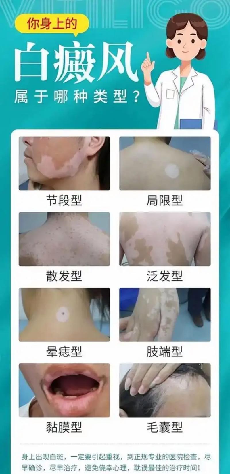 白癜风怎么命名的白癜风怎么地的 白癜风怎么命名的白癜风怎么地的