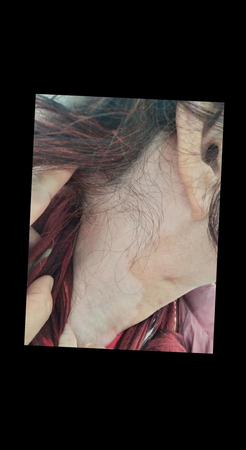 郑州白癜风症状和怀孕 郑州白癜风症状和怀孕