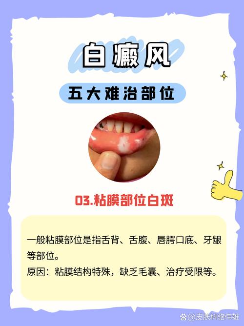 成都白癜风怎么治疗有效 如何科学治疗儿童白癜风 成都白癜风怎么治疗有效 如何科学治疗儿童白癜风