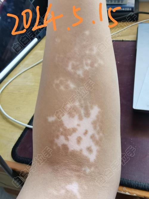 白癜风日常怎么护理 白癜风养护 白癜风日常怎么护理 白癜风养护