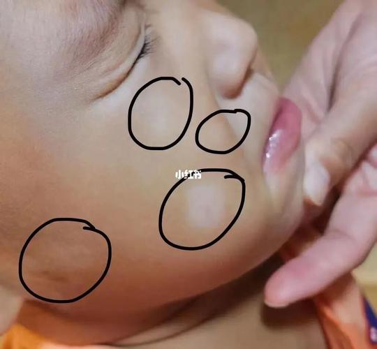 武汉什么是白癜风 武汉白癜风怎样治疗效果最好 武汉什么是白癜风 武汉白癜风怎样治疗效果最好