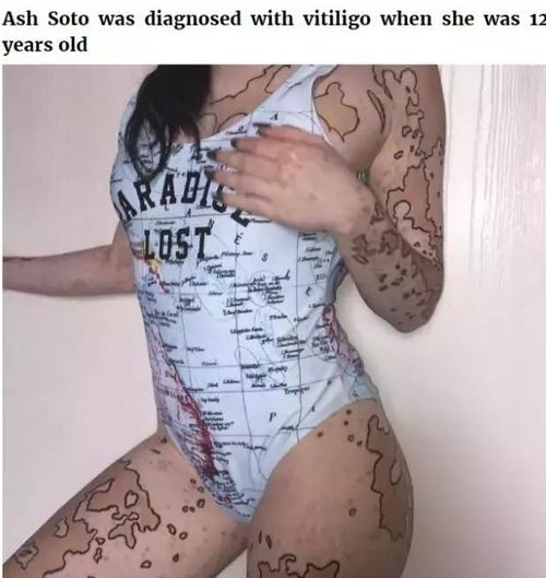 国内什么医院治疗白癜风 国内什么医院治疗白癜风