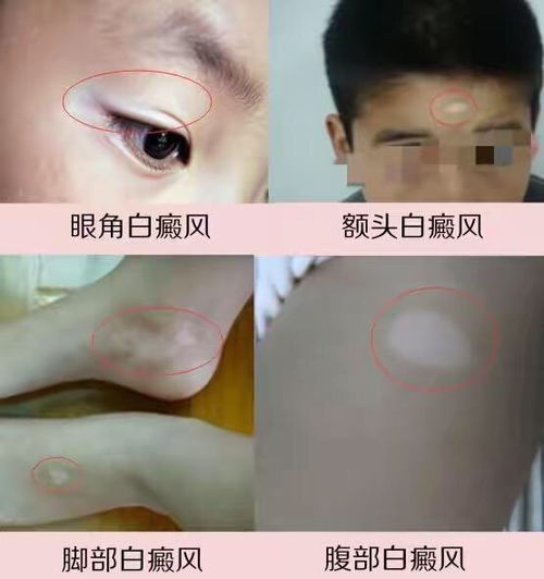 激素药膏引起的白癜风 激素药膏引起的白癜风