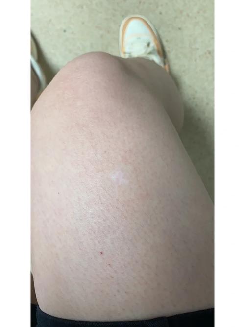 白癜风夏季可以使用防晒霜吗 绥化治白癜风哪个医院专业 白癜风夏季可以使用防晒霜吗 绥化治白癜风哪个医院专业